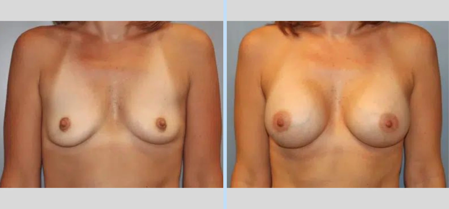 Breast Augmentation Before & After - Case 3 Banner
