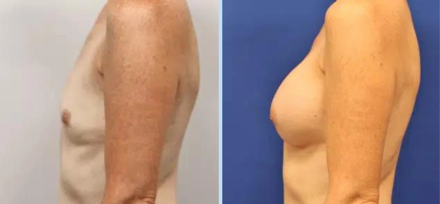 Breast Augmentation Before & After - Case 4 Banner