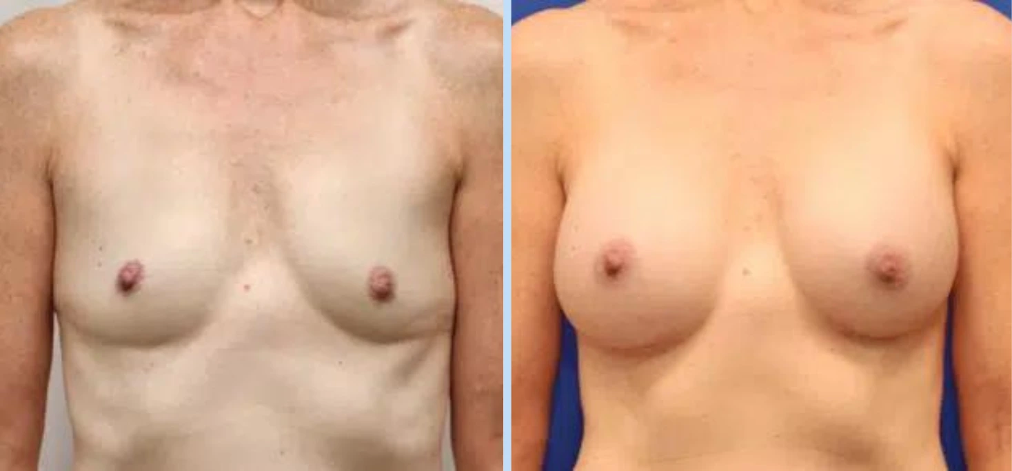 Breast Augmentation Before & After - Case 4 Banner