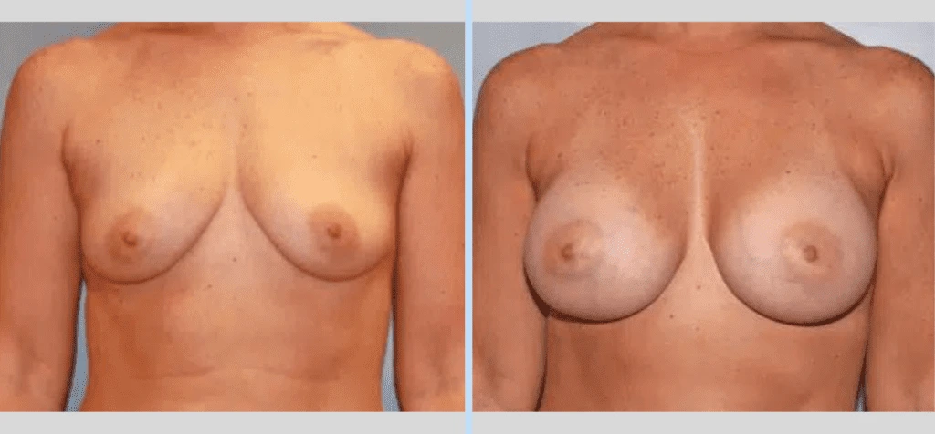 Breast Augmentation Before & After - Case 6 Banner