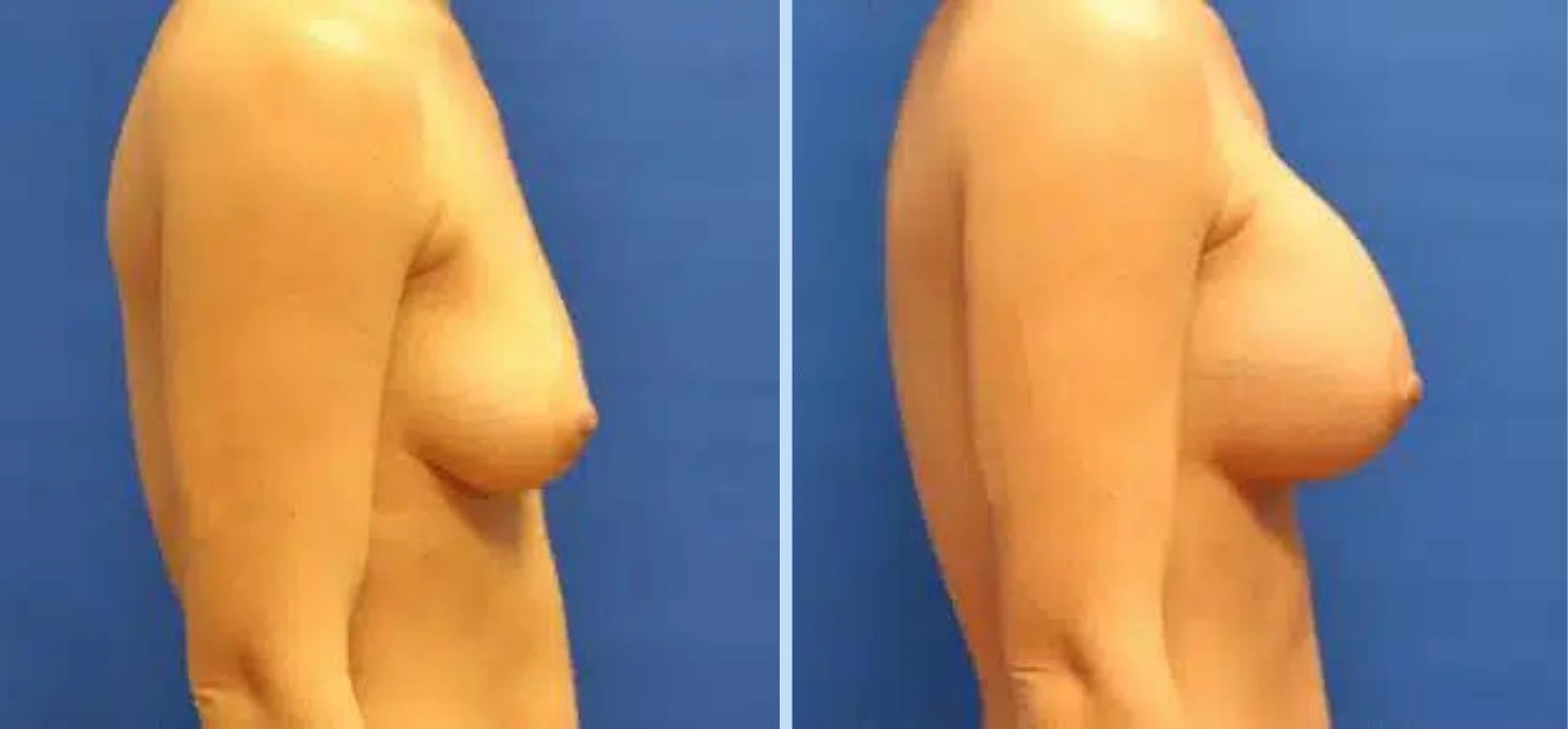 Breast Augmentation Before & After - Case 8 Banner