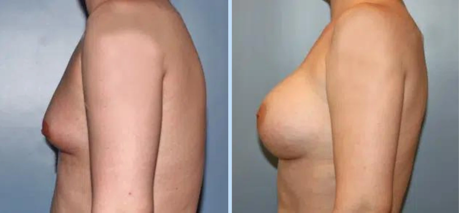 Breast Augmentation Before & After - Case 9 Banner