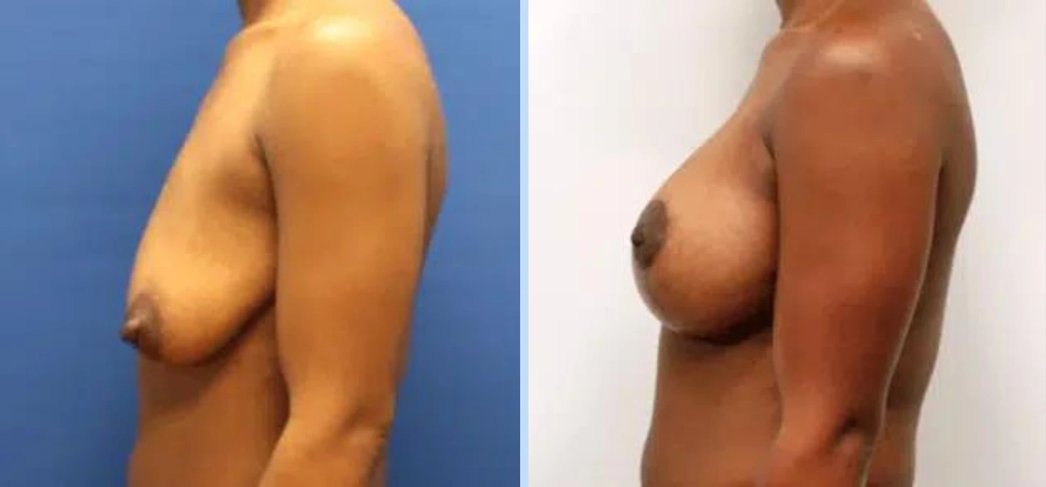 Breast Lift Before & After - Case 1