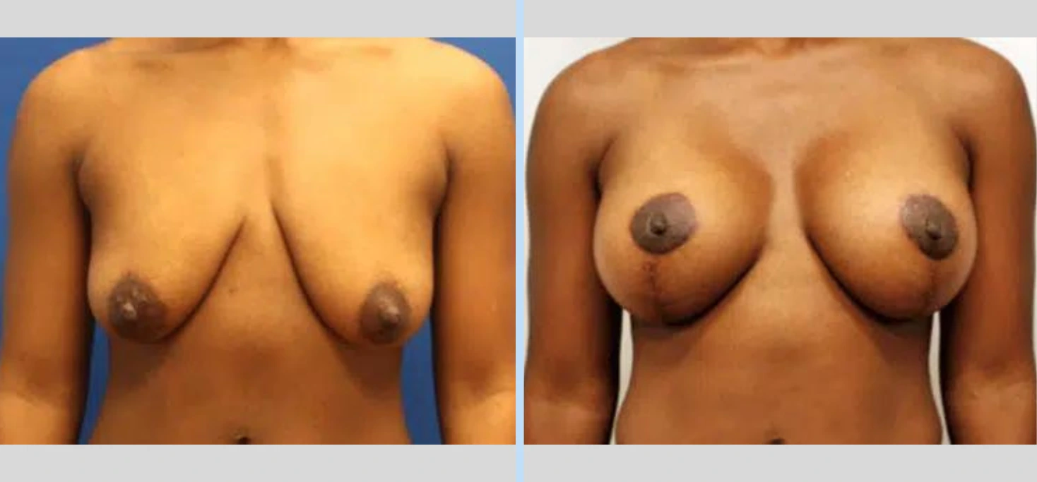Breast Lift Before & After - Case 1