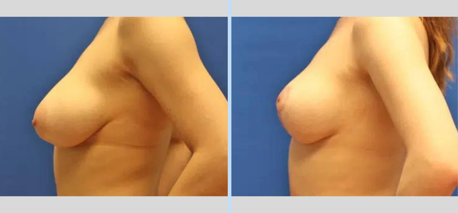 Breast Lift Before & After - Case 2