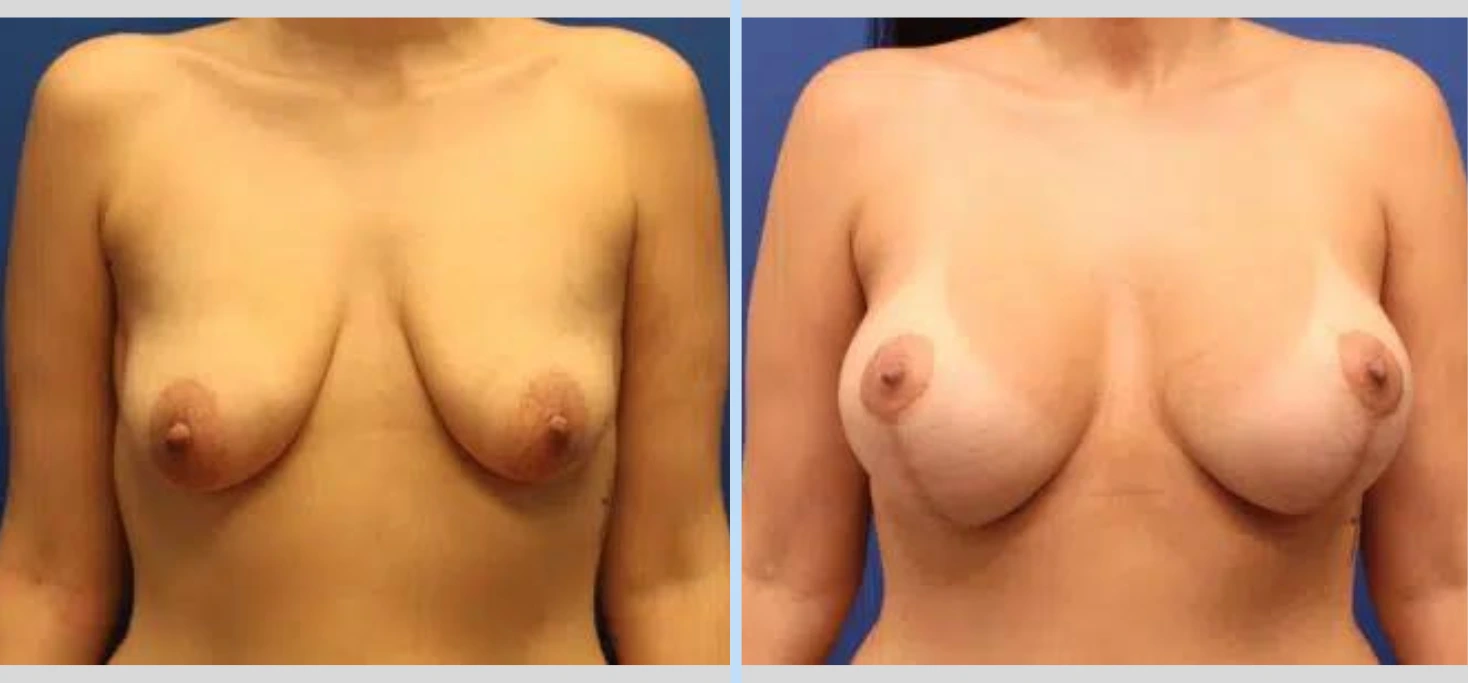 Breast Lift Before & After - Case 3