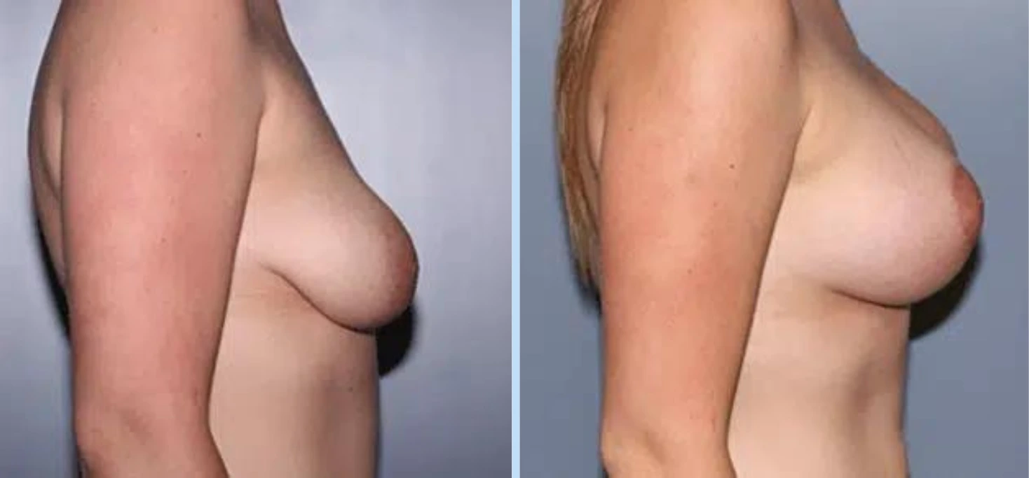 Breast Lift Before & After - Case 4
