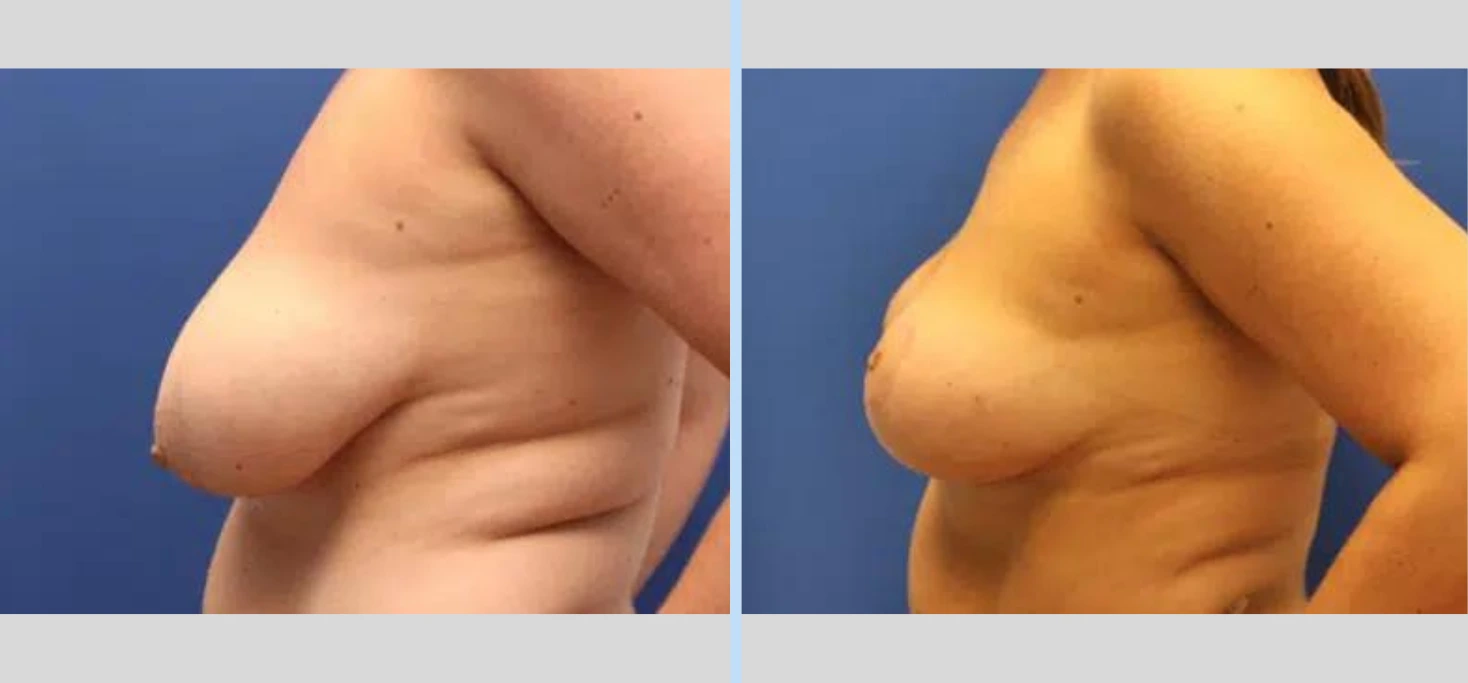 Breast Lift Before & After - Case 5