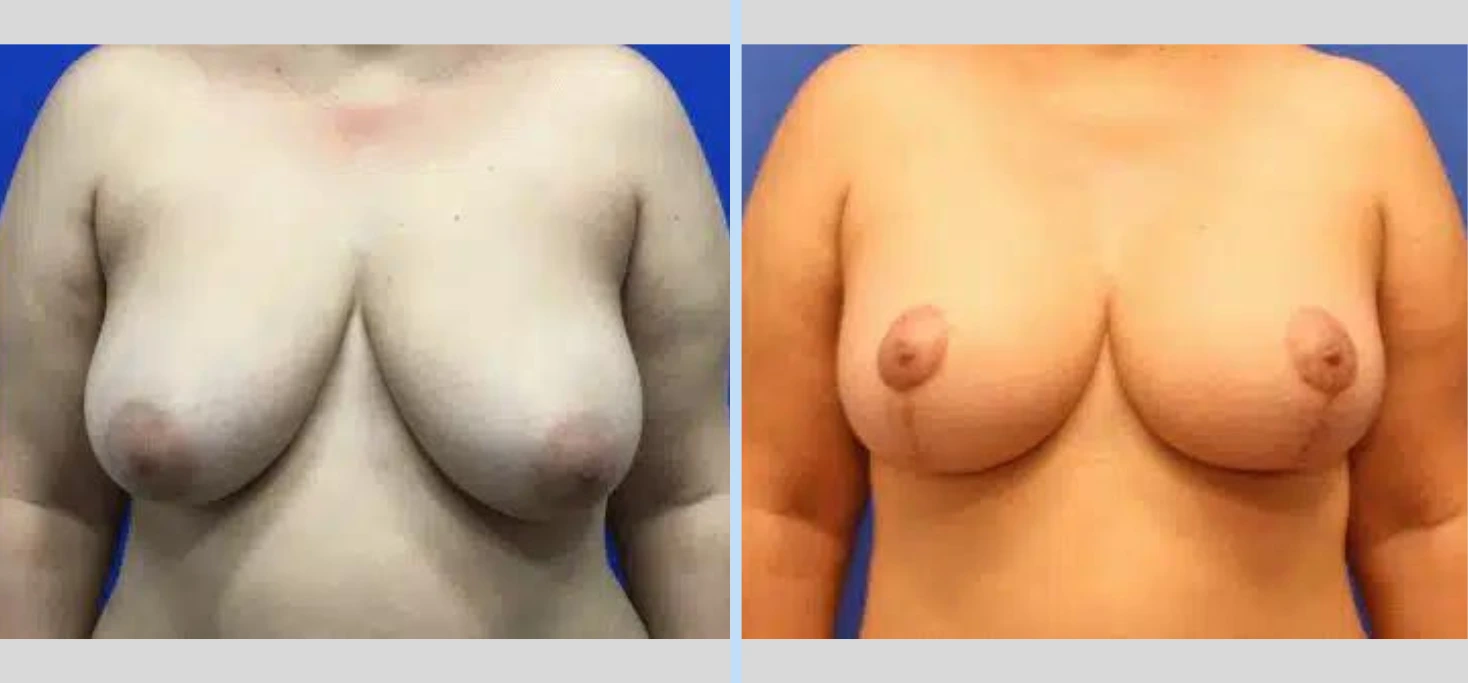 Breast Lift Before & After - Case 6