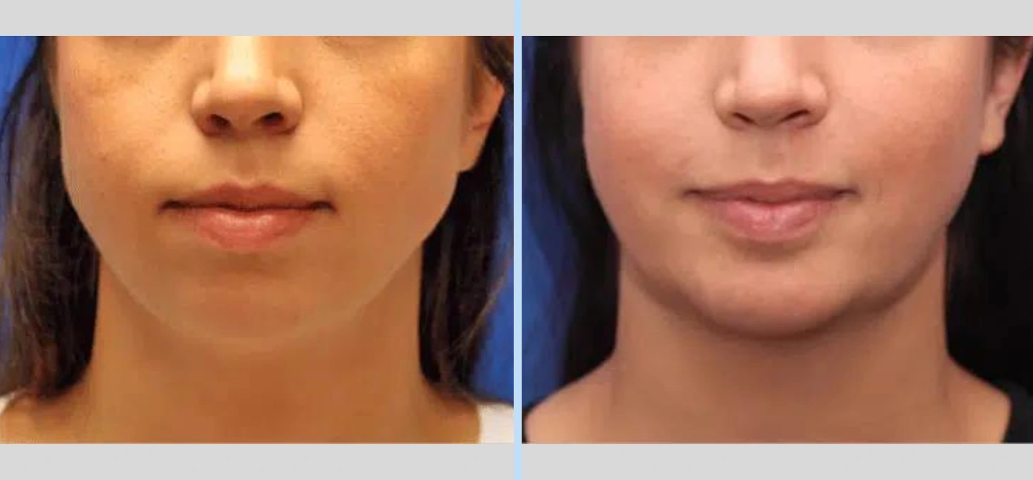 Chin Augmentation Before & After - Case 1