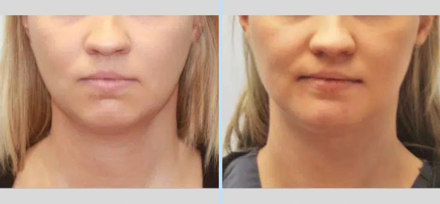 Chin Augmentation Before & After - Case 2