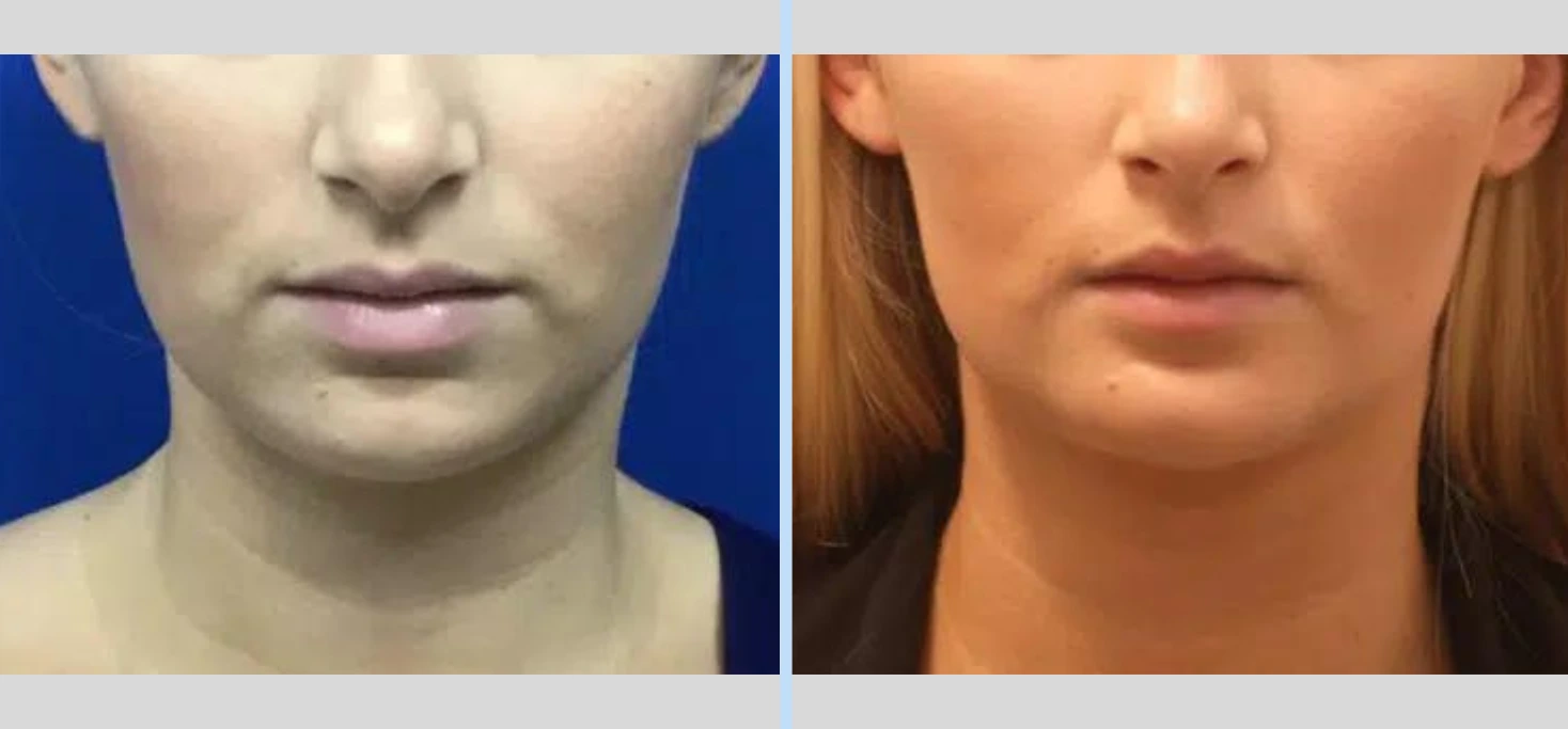 Chin Augmentation Before & After - Case 3