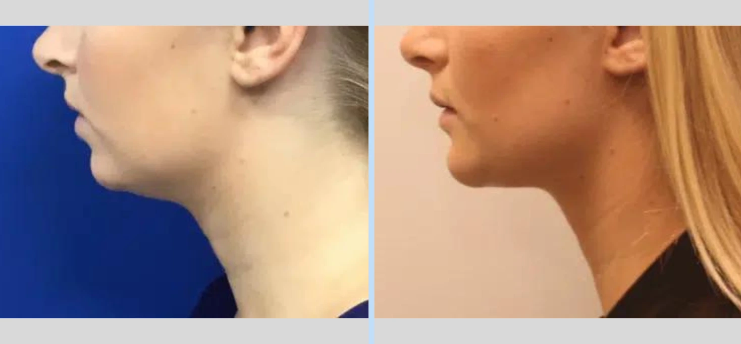 Chin Augmentation Before & After - Case 3