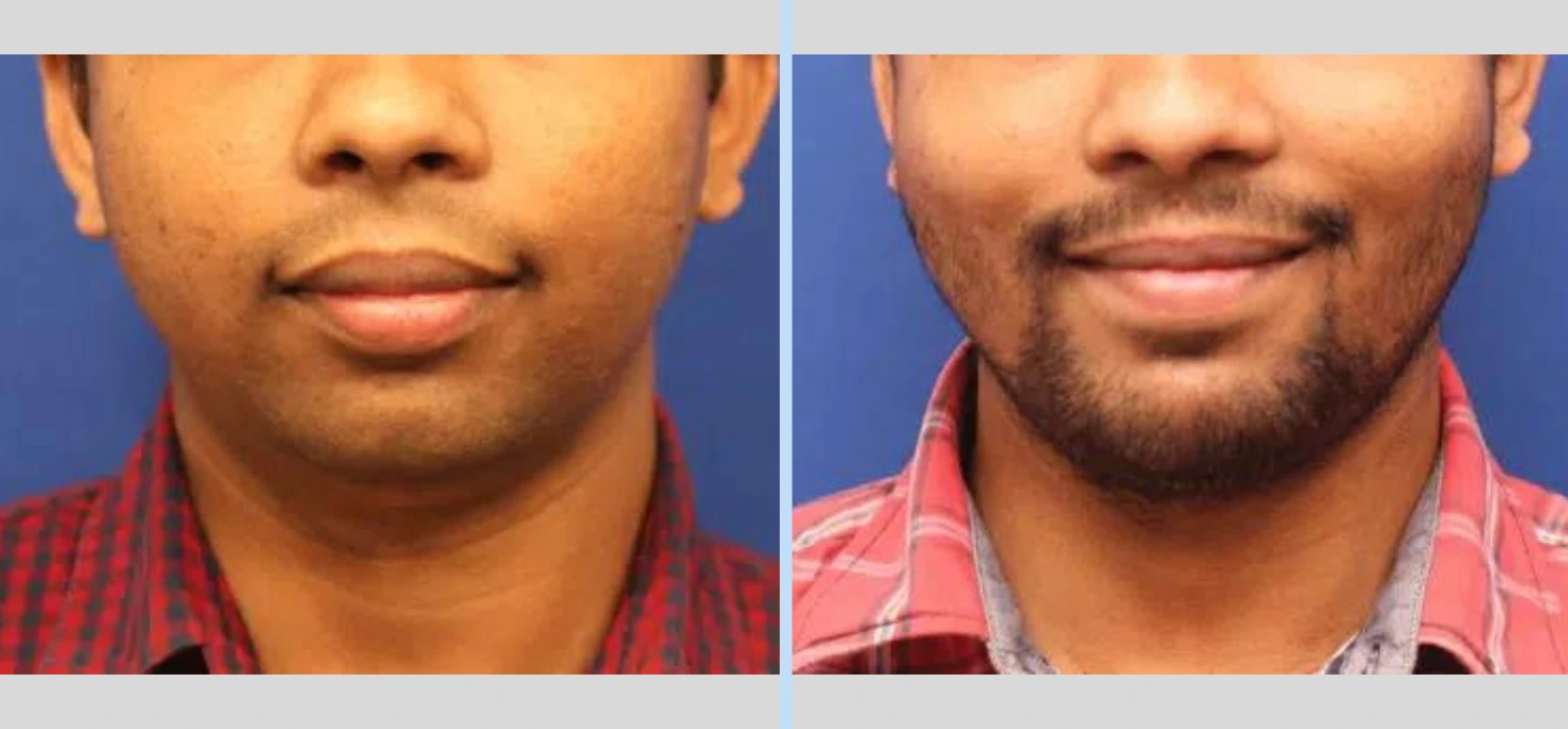 Chin Augmentation Before & After - Case 5