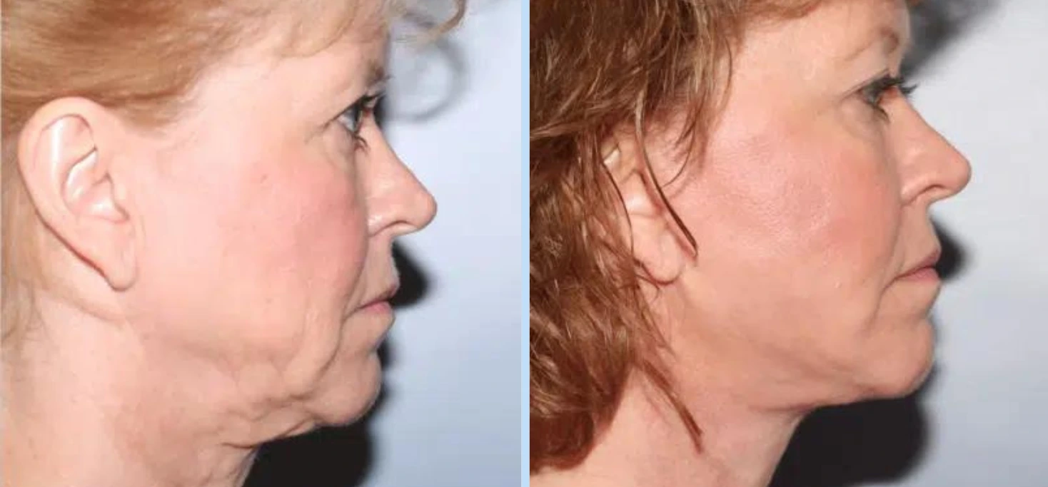 Facelift Before & After - Case 1