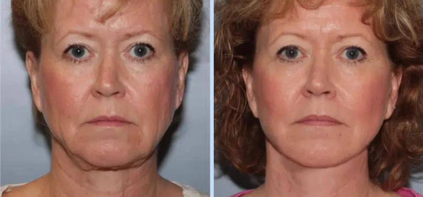 Facelift Before & After - Case 1