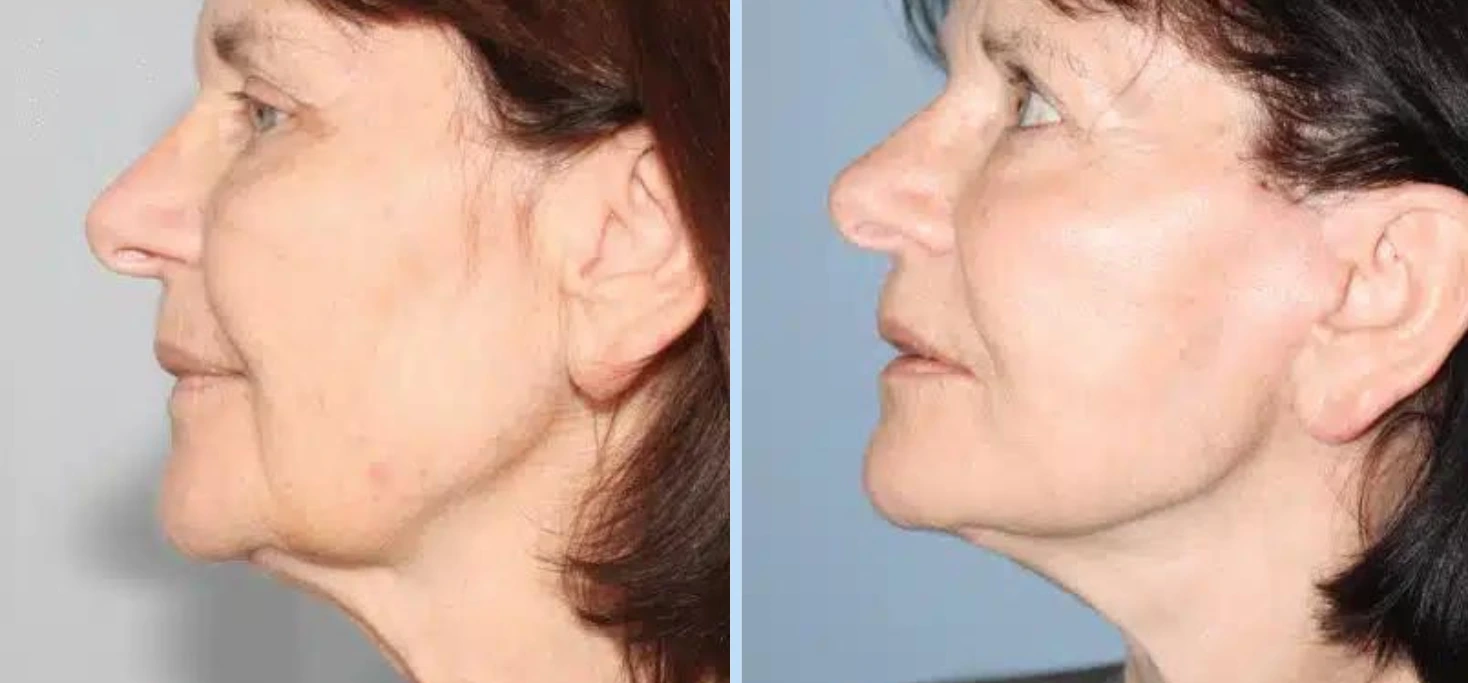 Facelift Before & After - Case 2