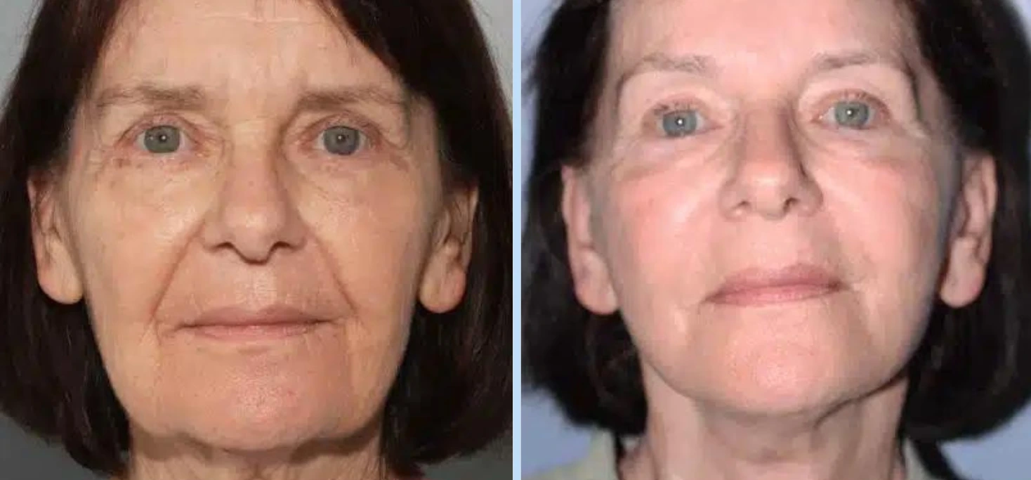 Facelift Before & After - Case 2