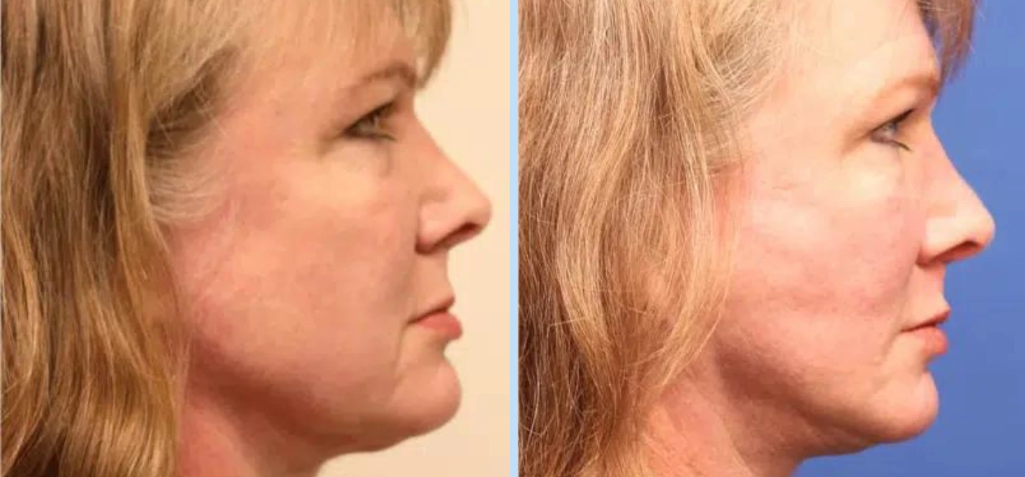 Facelift Before & After - Case 3