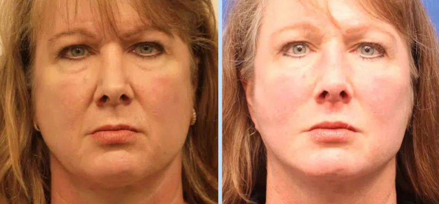 Facelift Before & After - Case 3