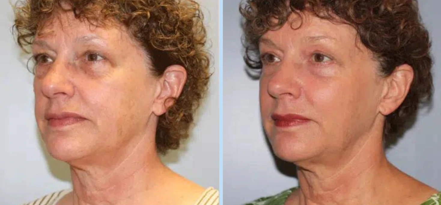 Facelift Before & After - Case 5