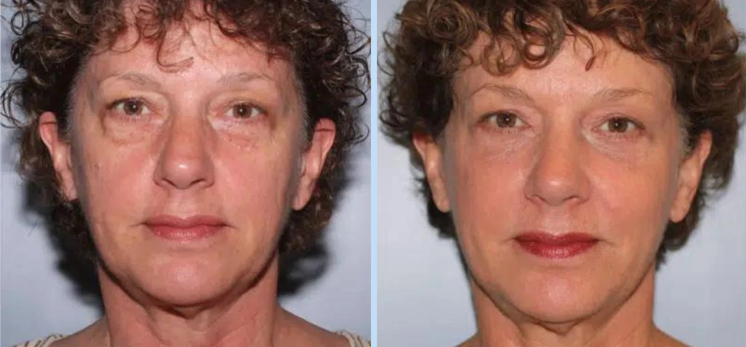 Facelift Before & After - Case 5