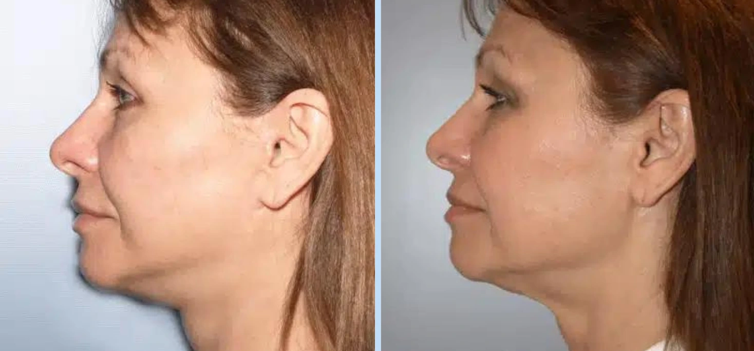 Facelift Before & After - Case 6