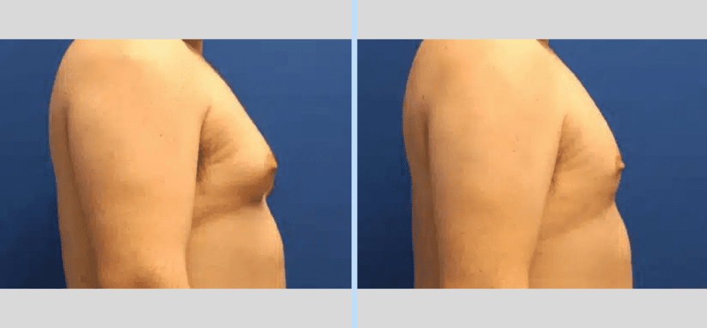 Gynecomastia Before & After - Case 1