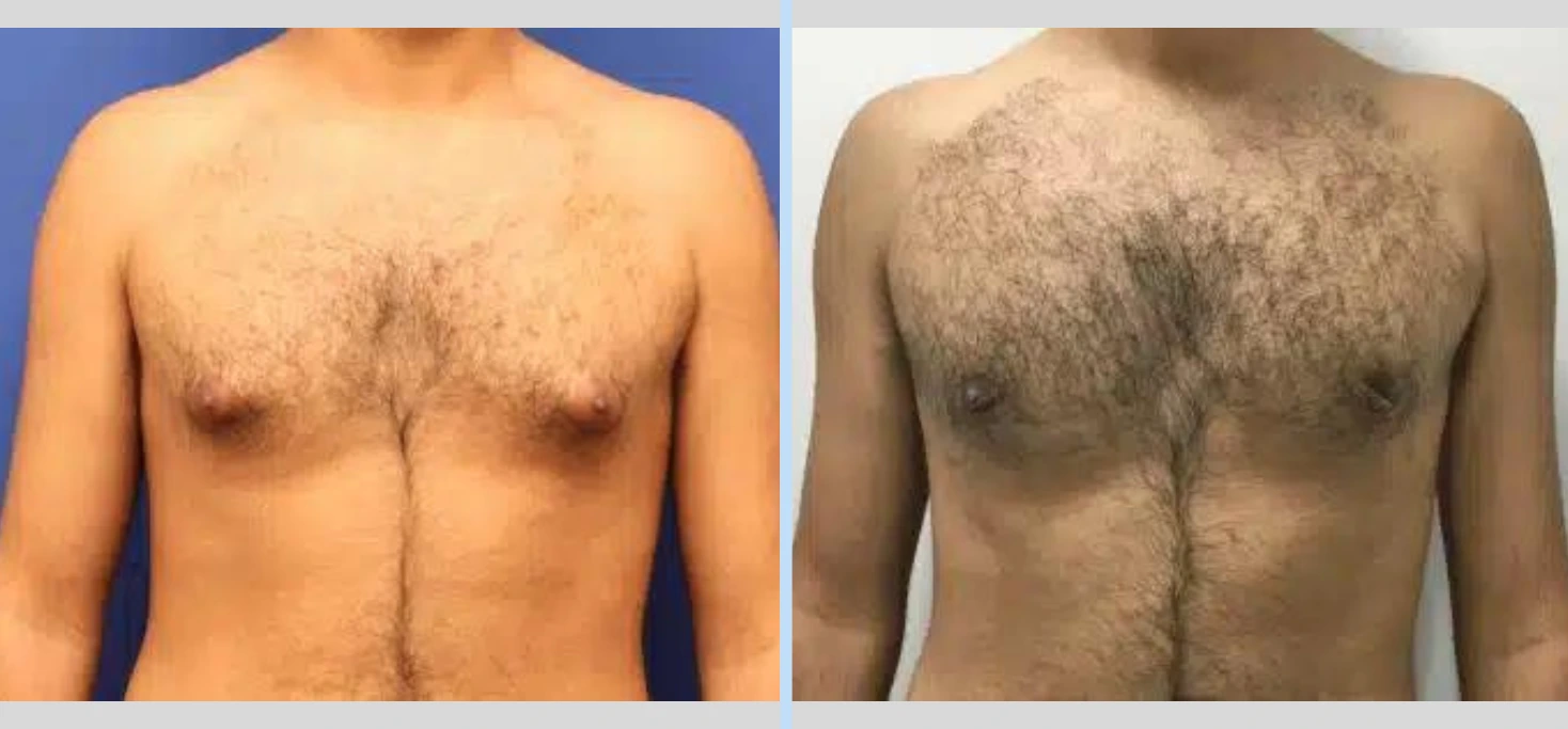 Gynecomastia Before & After - Case 2