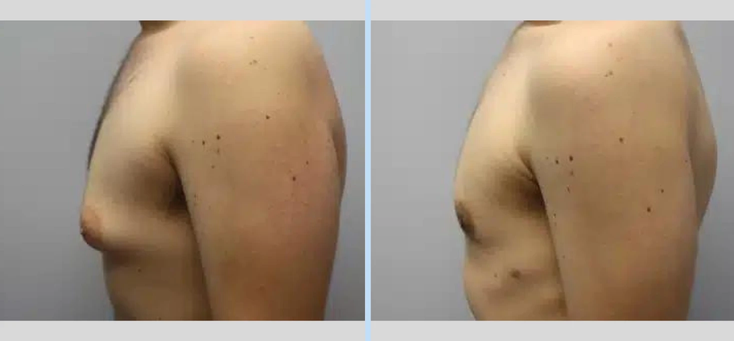 Gynecomastia Before & After - Case 4