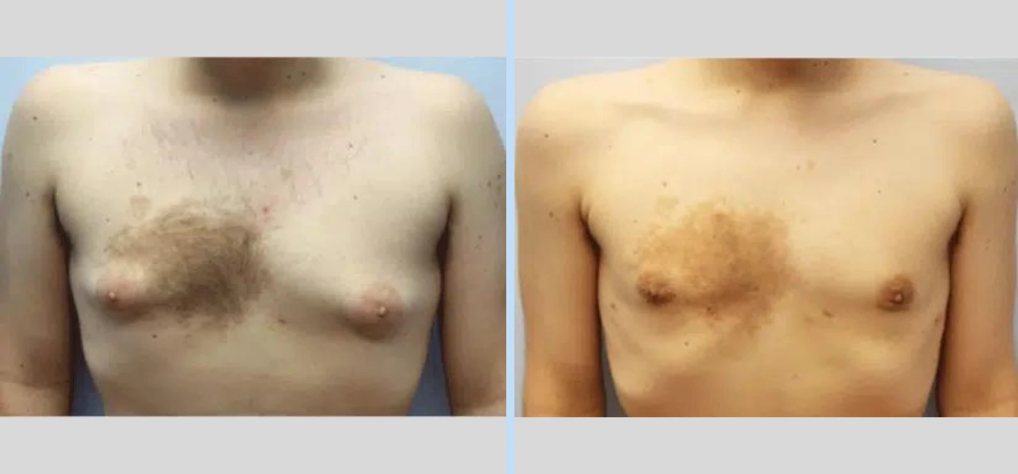 Gynecomastia Before & After - Case 4