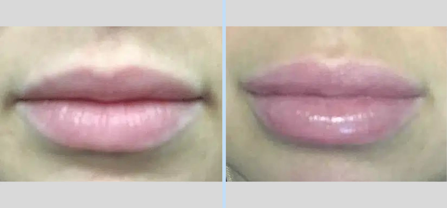 Injectables Before & After – Case 10