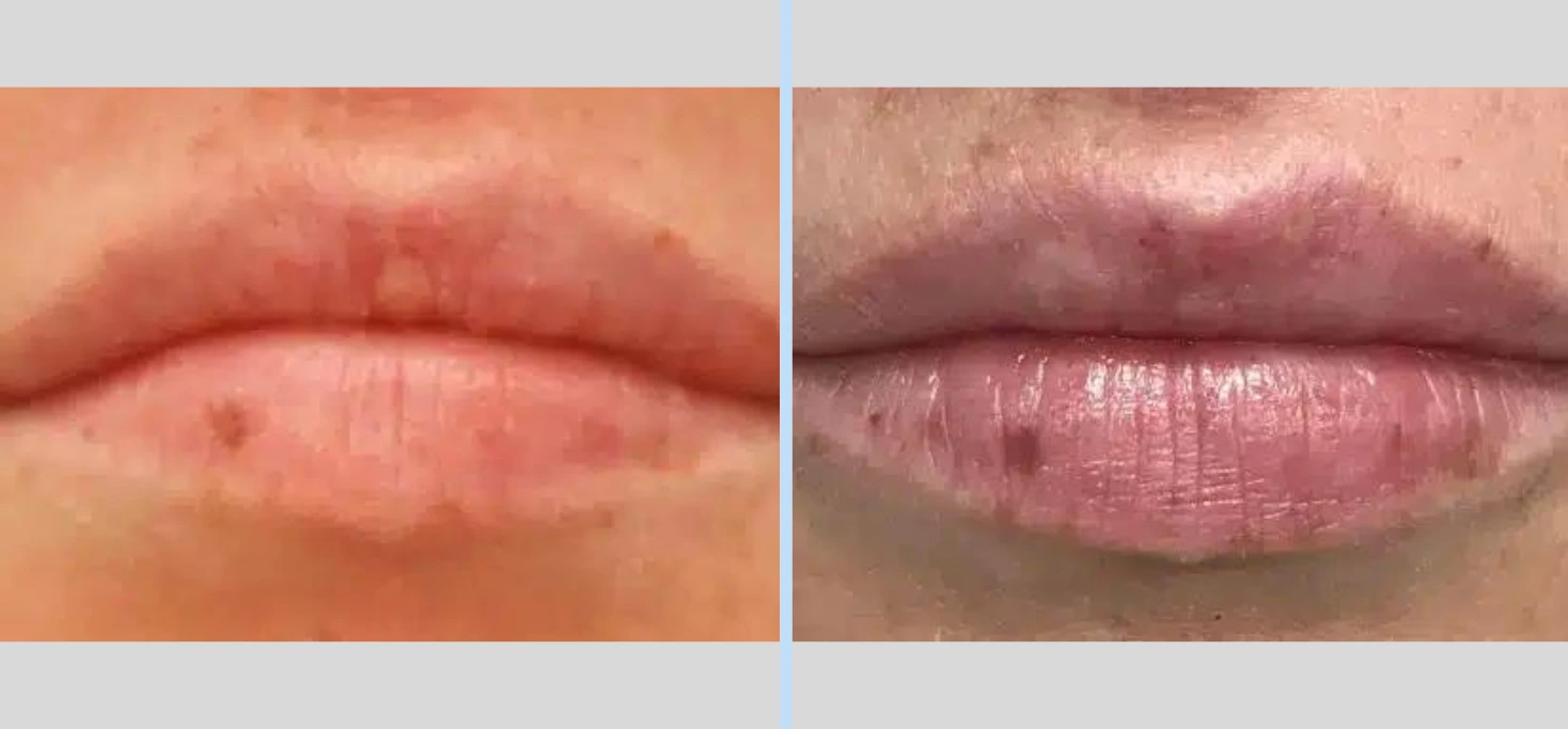 Injectables Before & After - Case 2