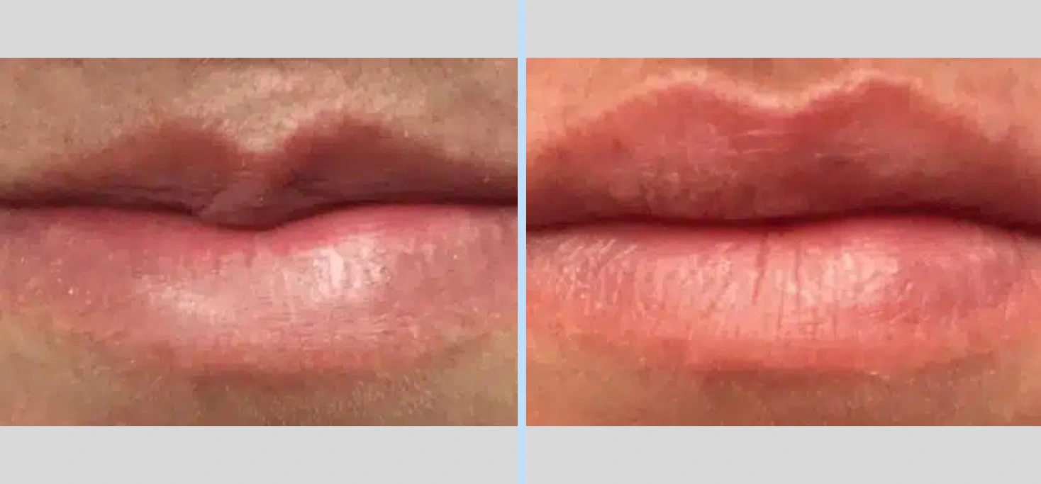 Injectables Before & After - Case 3