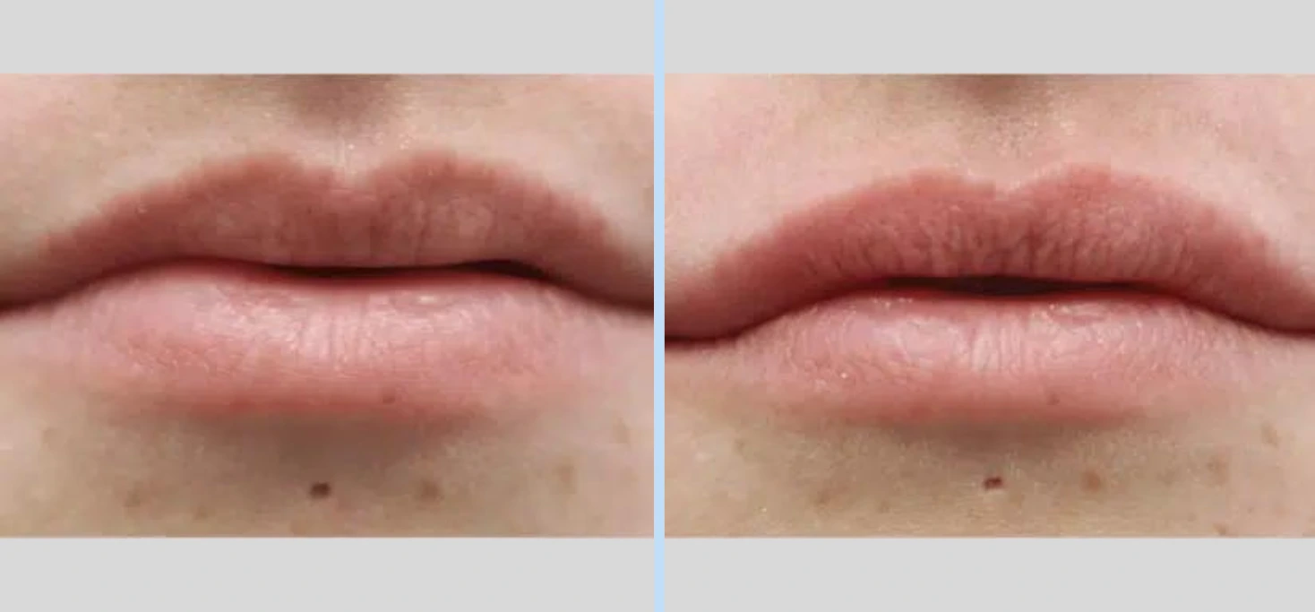 Injectables Before & After - Case 4
