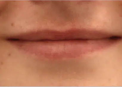 Injectables Before & After – Case 5