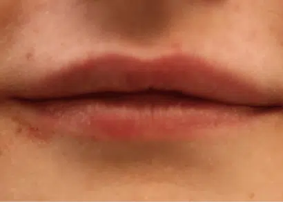 Injectables Before & After – Case 5