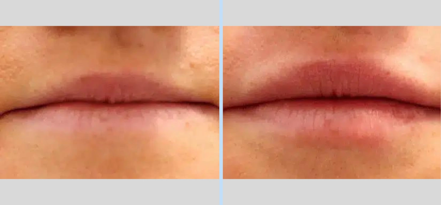 Injectables Before & After – Case 6