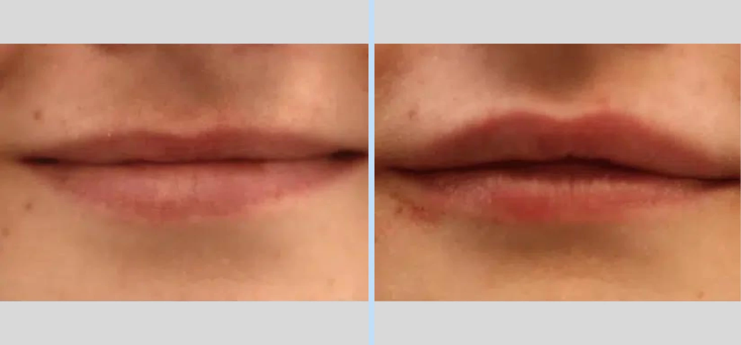 Injectables Before & After – Case 7
