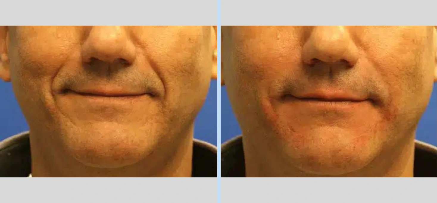 Injectables Before & After – Case 8