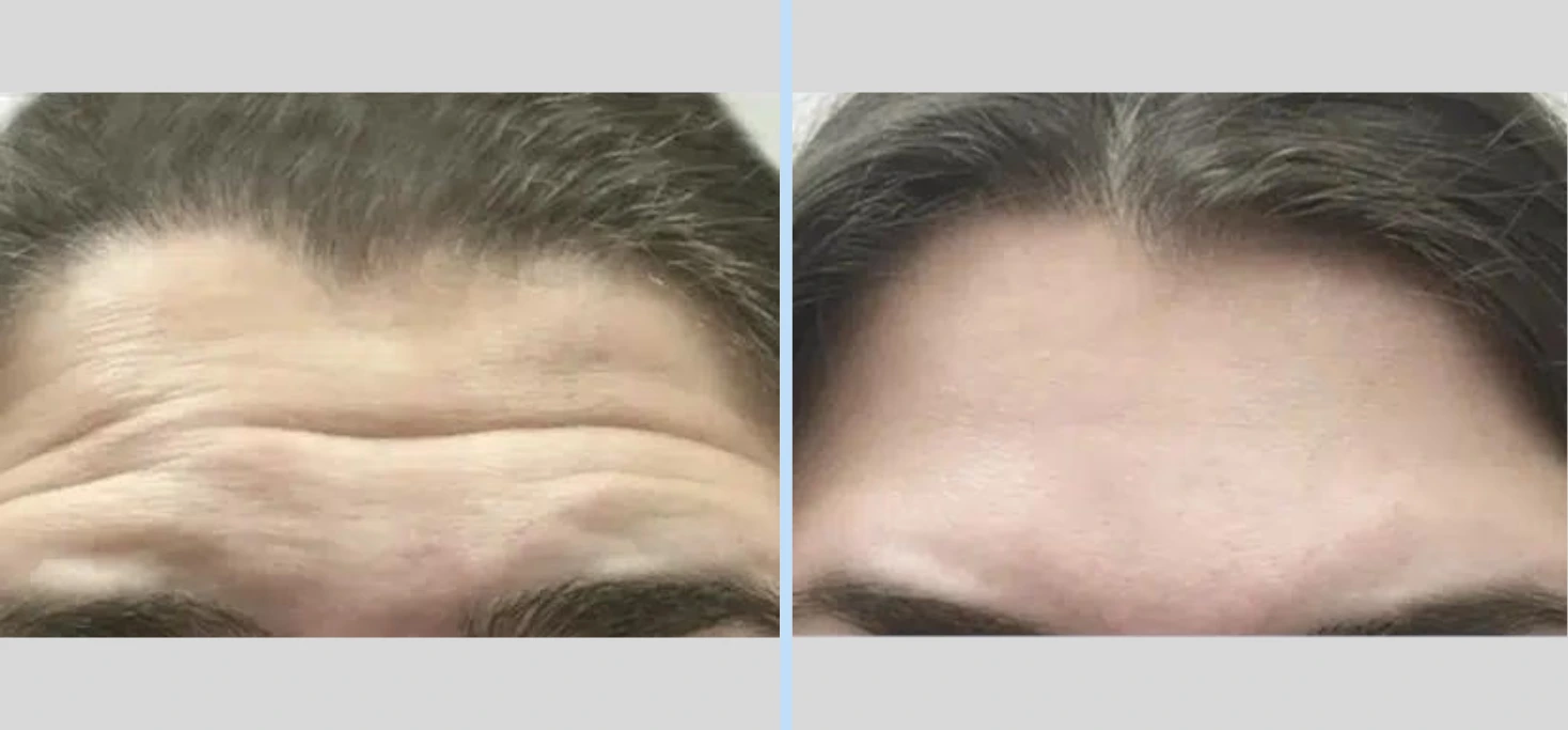 Injectables Before & After – Case 9