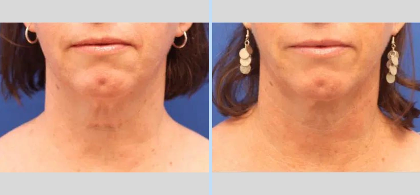 Laser Neck Lift Before & After - Case 1