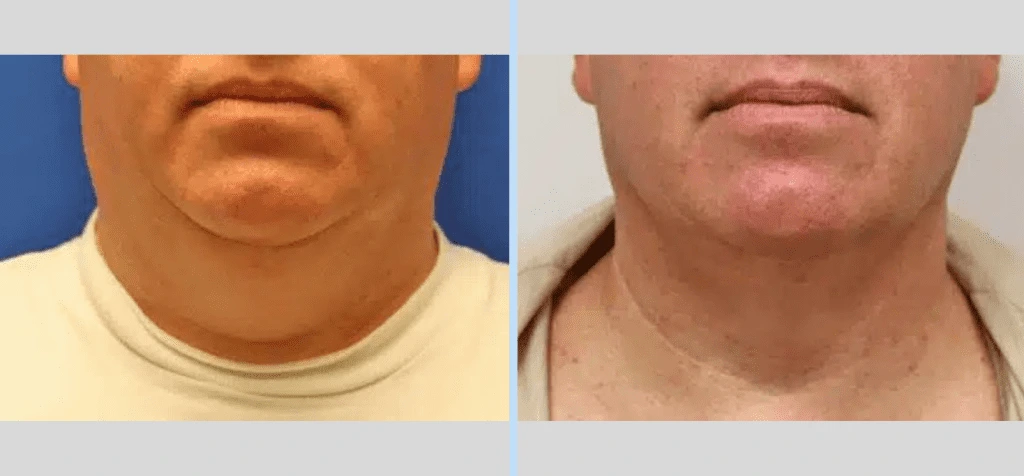 Laser Neck Lift Before & After - Case 5