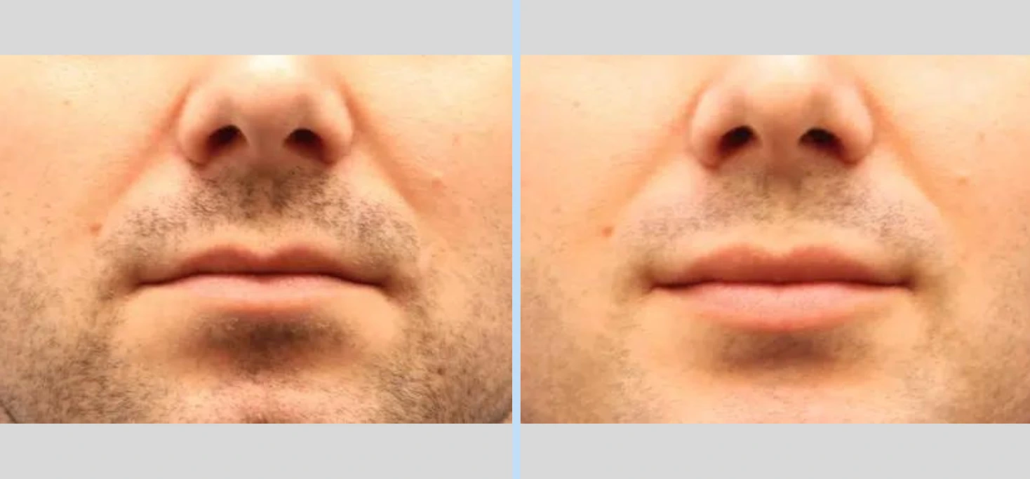 Lip Augmentation Before & After - Case 1
