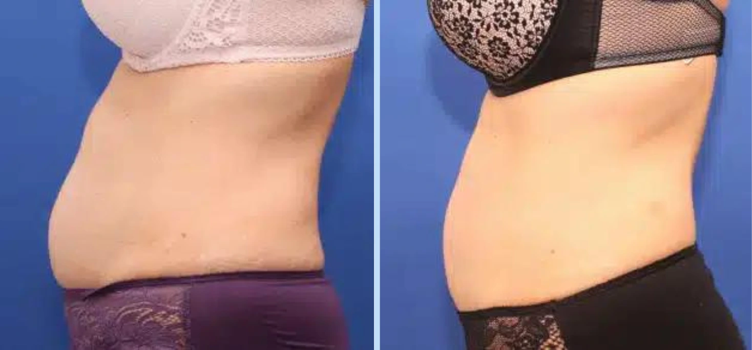 Mini Tummy Tuck Before & After – Case 1 Banner
