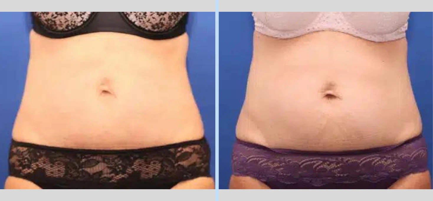 Mini Tummy Tuck Before & After – Case 1 Banner