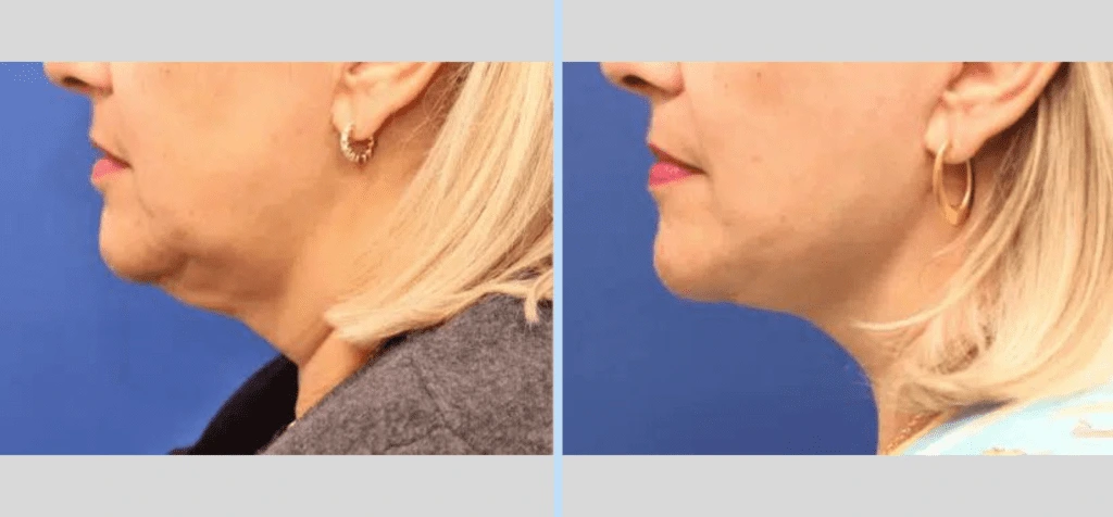 Neck Lift Before & After - Case 2