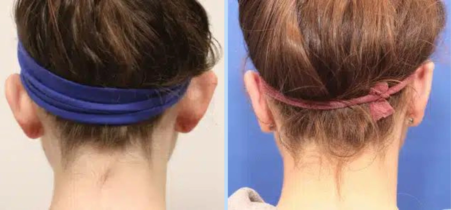 Otoplasty Before & After - Case 1