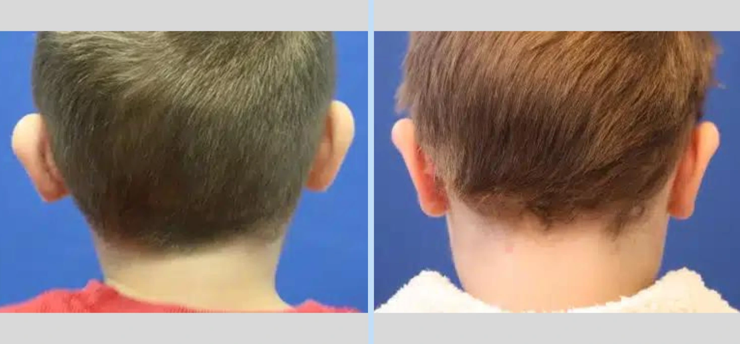 Otoplasty Before & After - Case 2