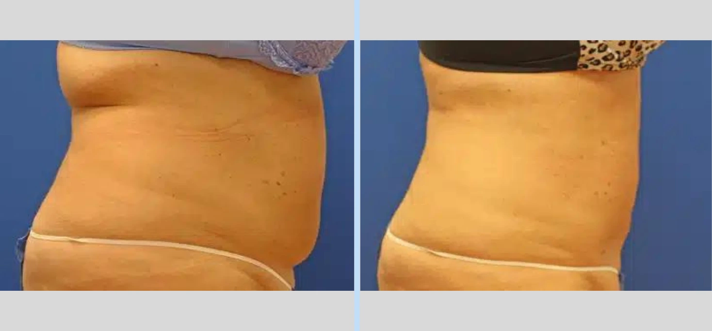 SmartLipo Before & After - Case 2 Banner